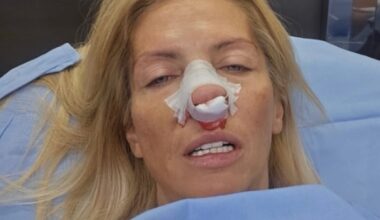 ODBORNICA KRENI-PROMENI OPERISANA NAKON NAPADA ŠAPIĆA: Tatjana Mićić zadobila prelome kostiju nosa i vilice!